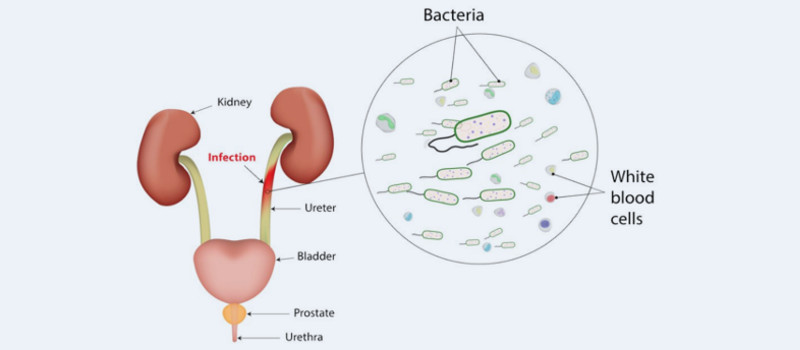 kidney stone disease 1